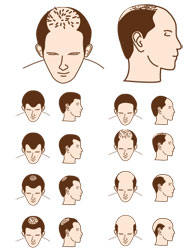 Tipi di alopecia maschile