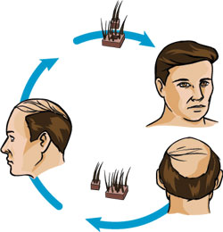 Trapianto di capelli e trattamenti anti calvizie