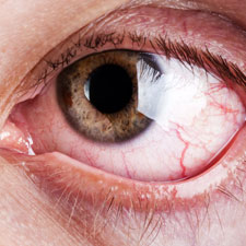 Herpes oculare, quando lherpes zoster colpisce gli occhi